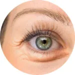 blefaroplastia girona