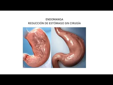 Endomanga gástrica · Medics Integral Salut