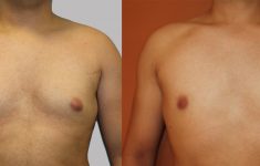 antes y después de ginecomastia