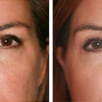 antes y después de tratamiento de ojeras