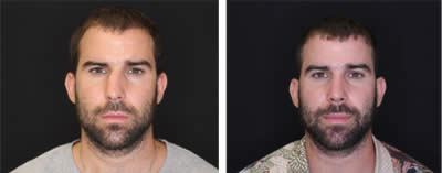 rinoplastia-antes-despues-1