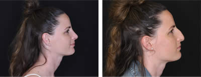 rinoplastia-antes-despues-2