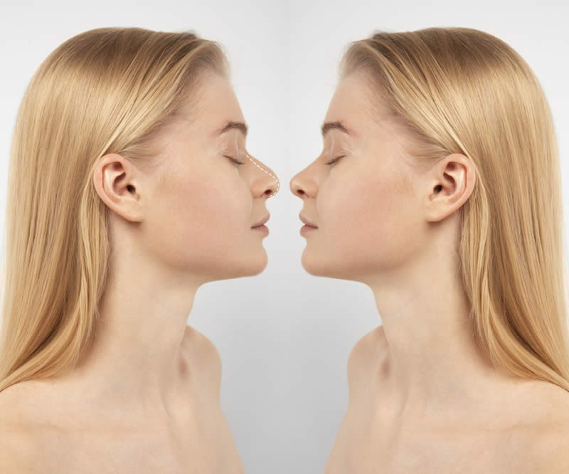 rinoplastia girona rinoplastia girona