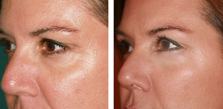 antes-despues-ojeras antes y después del tratamiento de ojeras