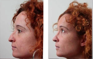 Rinoplastia recuperación fotos