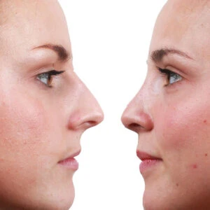 Rinoplastia recuperación fotos