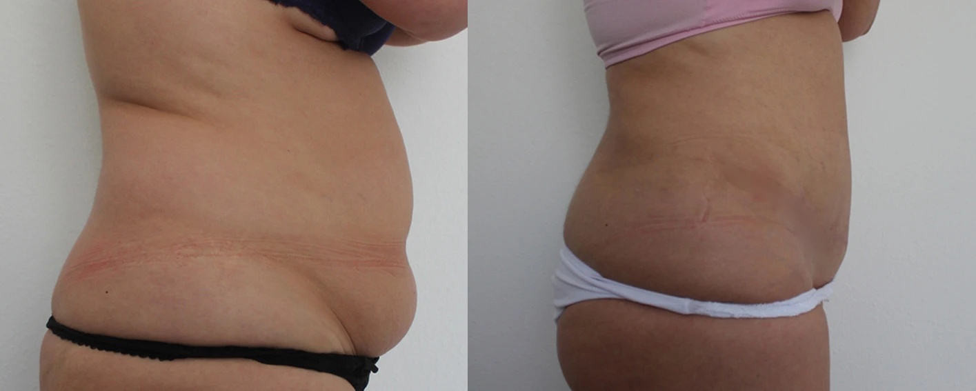 abdominoplastia girona