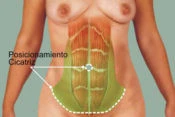 abdominoplastia girona