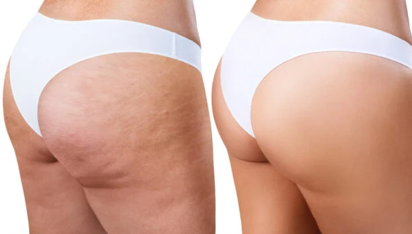 Cómo eliminar la celulitis