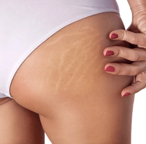 Tratamiento de celulitis · Medics Integral Salut