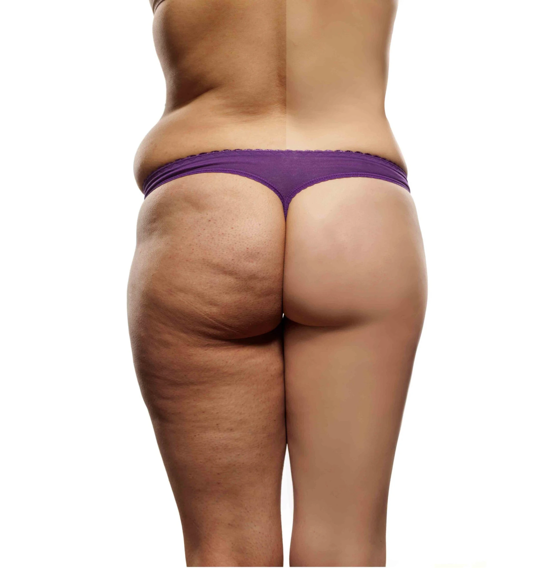 reduccion-volumen-girona