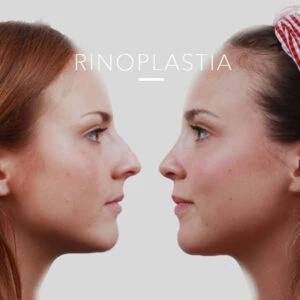 antes y después de rinoplastia