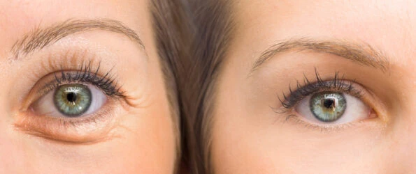 Tratamiento de ojeras en Girona