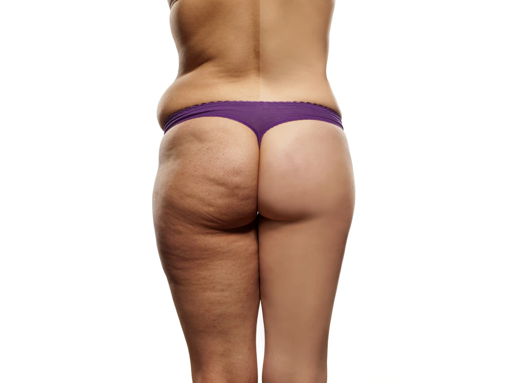 Female,Body,Before,And,After,Liposuction