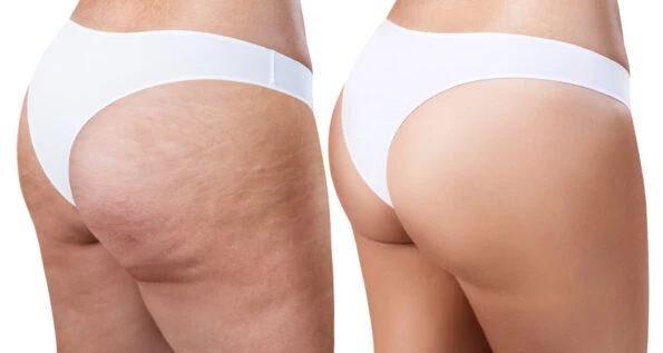 Eliminar celulitis en Girona · Medics Integral Salut
