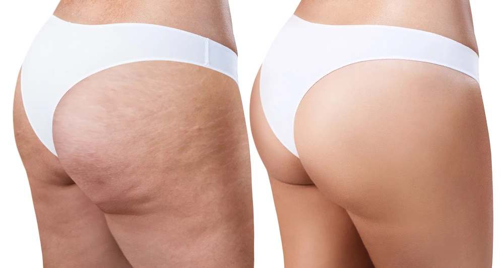 Female,Buttocks,Before,And,After,Treatment.