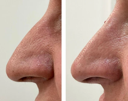 Foto de Medicstetics rinomodelacion web rinomodelacion rinoplastia sin cirugia