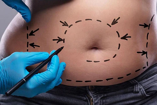 Abdominoplastia-girona cirugia postbariatrica