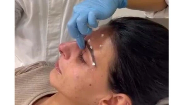 Rinoplastia o septoplastia