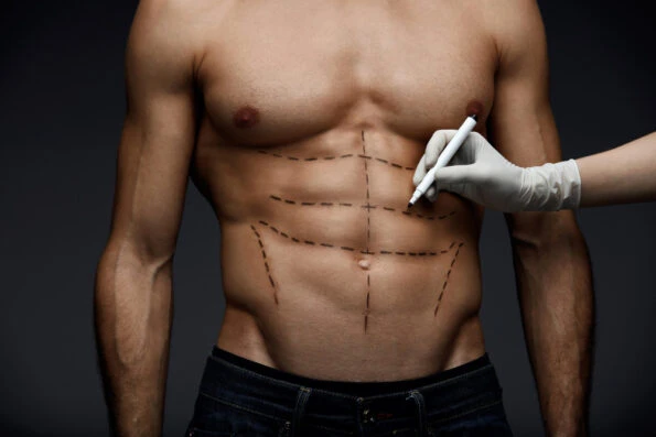 Diferencia entre lipo Váser y liposucción