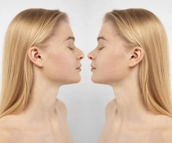 Rinoplastia en Girona · Medics Integral Salut