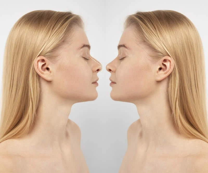 rinoplastia girona