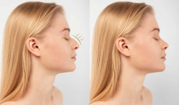 Recuperación de una rinoplastia
