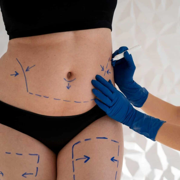 Abdominoplastia · Medics Integral Salut